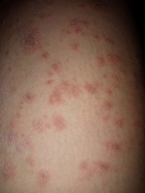 Gatal seluruh badan setelah melahirkan