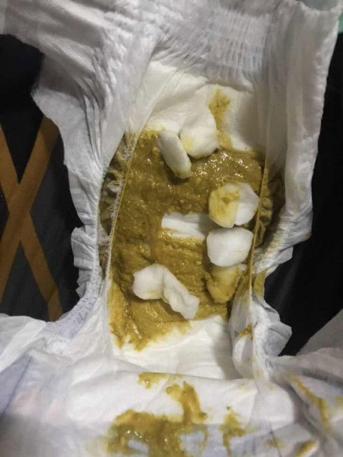 Bakit po ganito ang poop