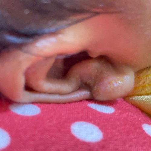 Bintik merah pada bayi