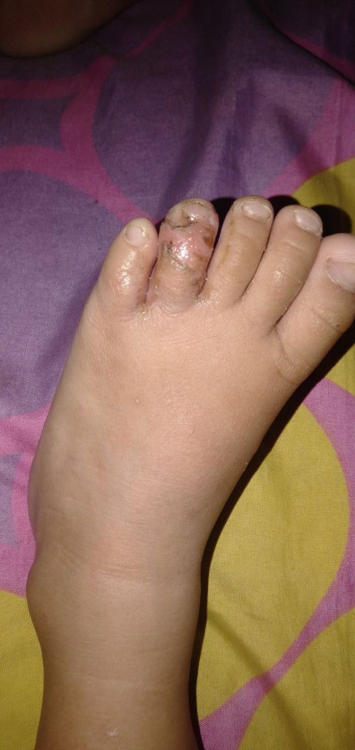 Luka di jari kaki anak
