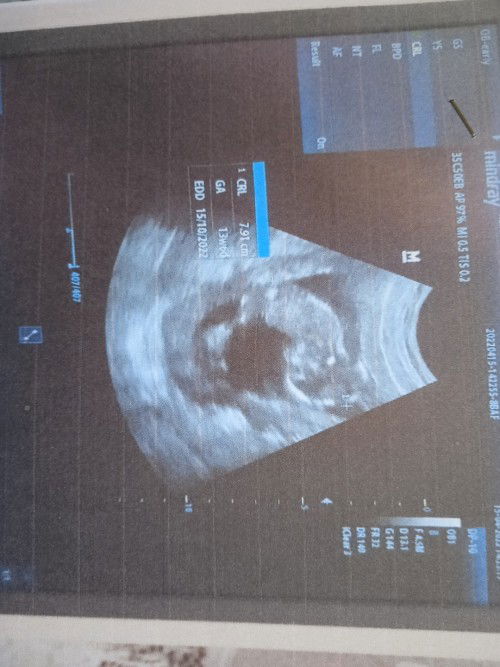 Bund mau sedikit cerita ni perkiraan hpl bidan sma USG beda