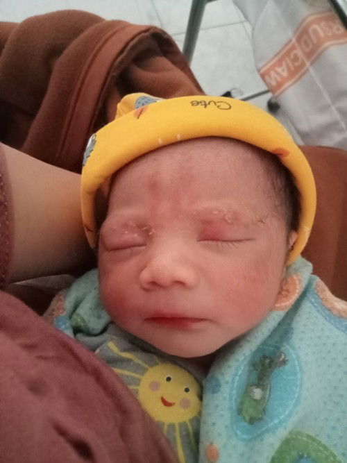 Tanda merah di muka bayi baru lahir