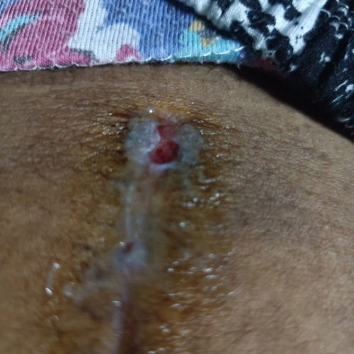 Help mga momsh na pa check ko na po sa ob yan binigyan lang po ako ointment and antibiotic cs mom aq