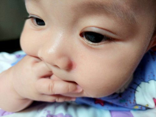 Sugat na hindi pa gumagaling