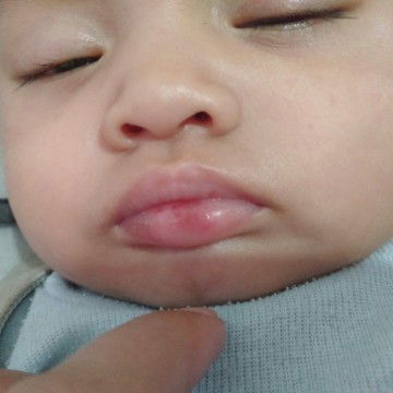 Luka pada bibir bayi