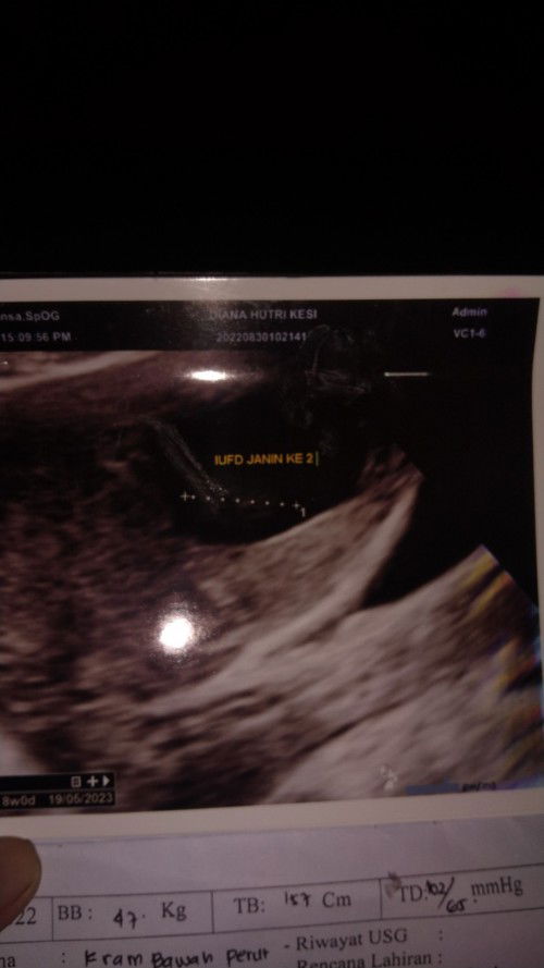 Usia 8 minggu aku USG, janinku kembar, tapi setelah USG di usia 11 Minggu, yg satunya meninggal
