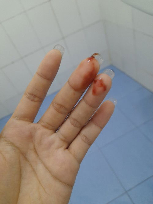 เรื่องฝังยาคุม3ปี