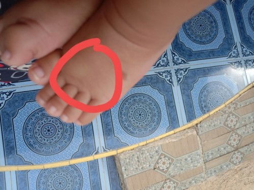 Kuning pada bayi 3 bulan