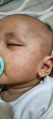 Bun, mau tanya donk obat buat muka si bayi kaya gini pakai apa yah ?