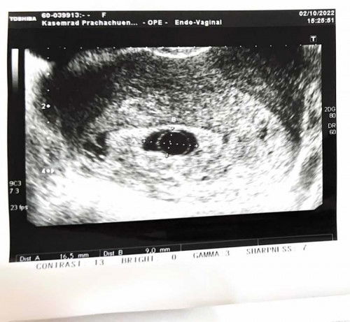 แชร์ประสบการณ์เกือบหมดหวัง ยาวหน่อยนะแม่ๆ