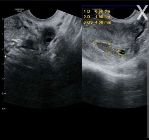 Pendarahan didekat kantung rahim