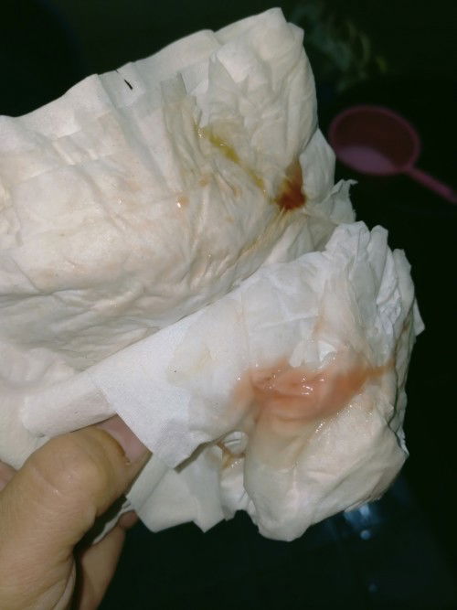 มีมูกเลือดออกแบบนี้ หลังจากโดนกวาดปากมดลูก