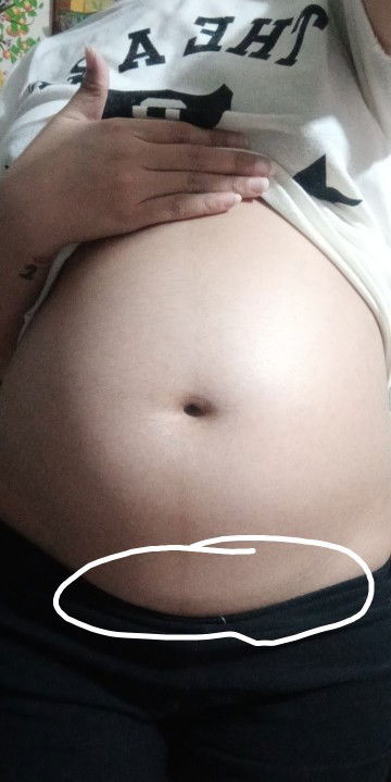 Sakit banda sa puson.