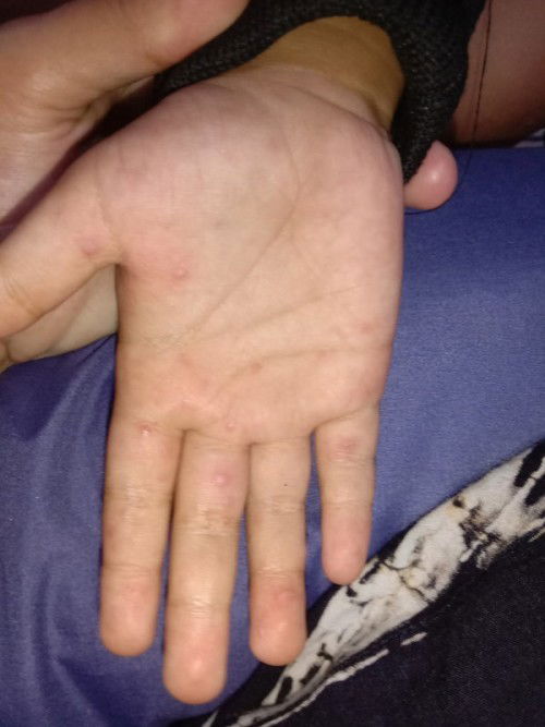 alergi daging dan ikan