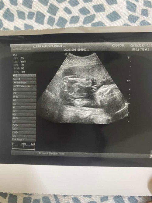 nak tanya mummy semua klu siapa yg tahu berkenaan scan baby