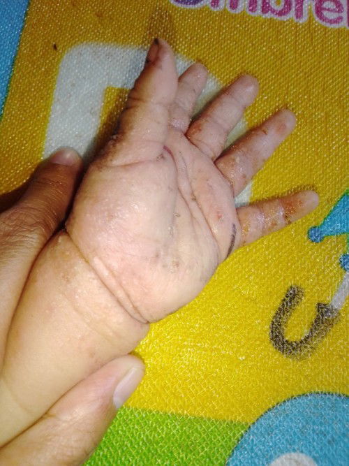 Ma mamshie pa help po anung mabisang gamot ganito may tubig po sa kamay at paa