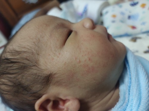 มีผื่นขึ้นบริเวณหัว หน้าผากและใบหน้า