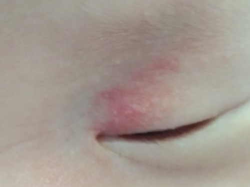 ลูกมีเปลือกตาแดงและมีตุ่ม
