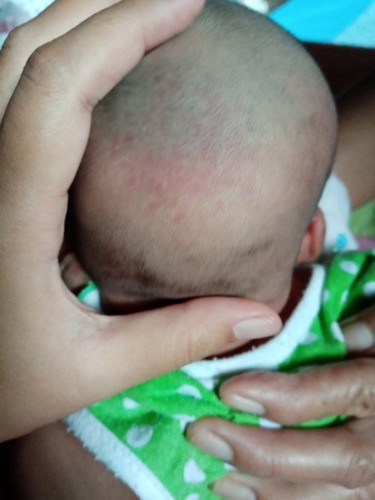 ผื่นแบบนี้เรียกว่าผื่นชนิดไหนค่ะ รบกวนผู้รู้ทุกคนค่ะ