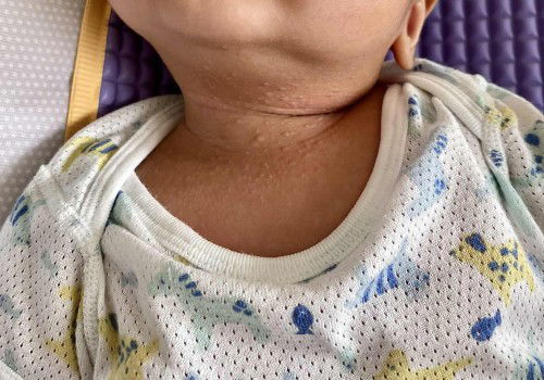 Neck rashes, any advice? baby is 3mths old. Anyone knows what is this?
