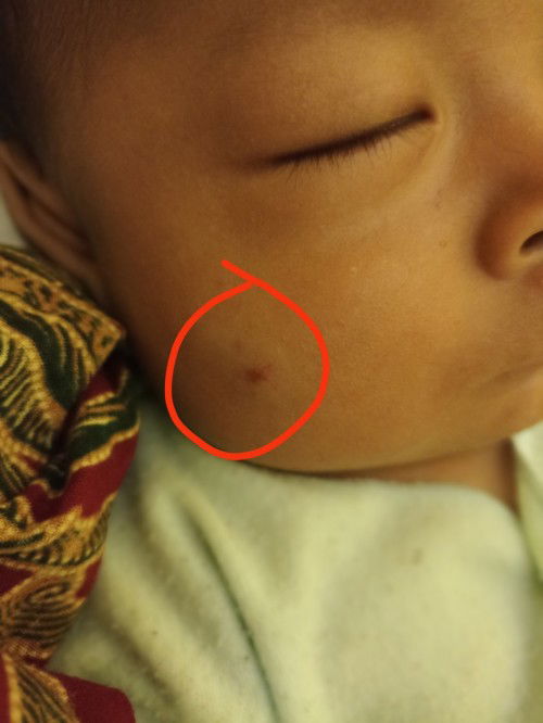Merah pada bayi