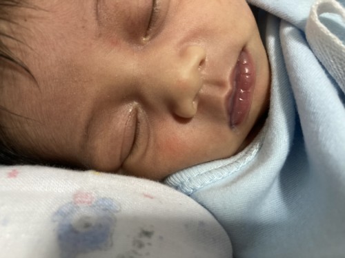 น้องพึ่งเกิดมีเม็ดสีแดงขึ้นตามหน้ากับตัว