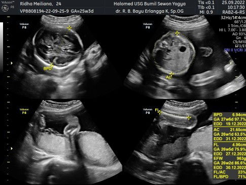 Berat badan janin.