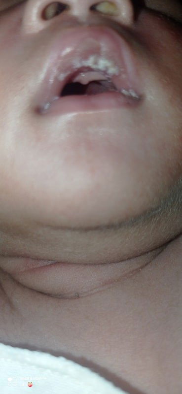 Bibir bayi bercak putih