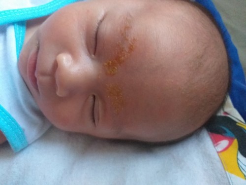Tanong ko lang po.
Anong po pwede ipahid sa ganito ni baby nung unang butlig butlig lang
