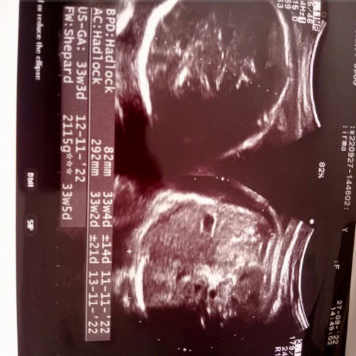 Cara membaca hasil usg