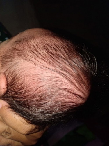 mabilis lang po ba bumalik sa normal yung bukol na malambot sa ulo ng baby ko? 3weeks nya po bukas