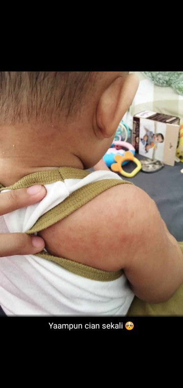 anak ruam merah" dan kering