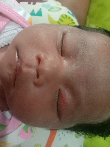 Belekan pada bayi
