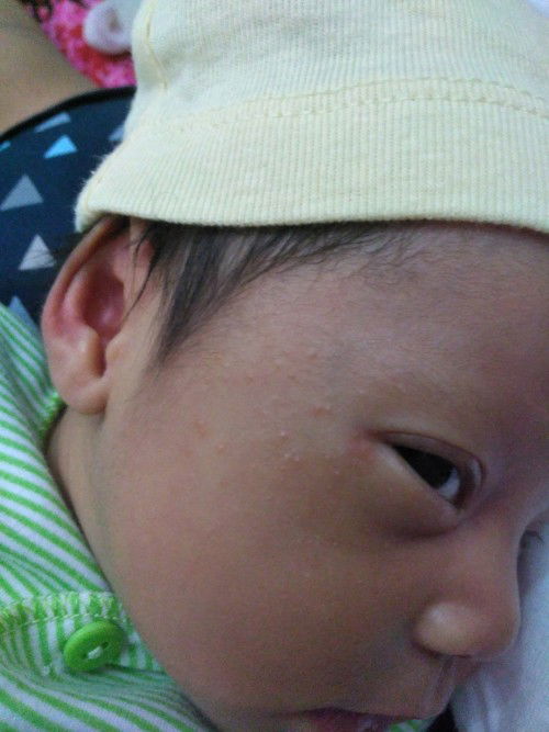 Bintik2 di wajah bayi