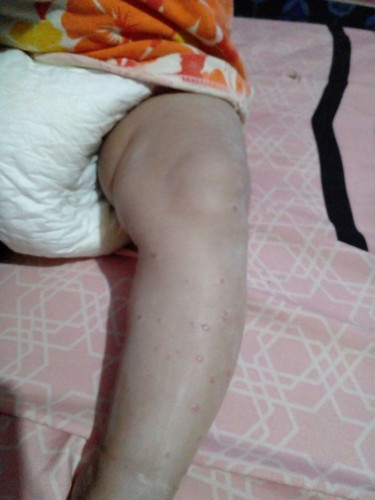ลูกมีเม็ดขึ้นที่ขากับแขนแบบนี้ควรใช้อะไรทาคะ