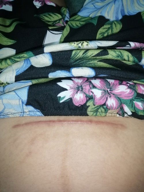 แผลผ่าคลอด