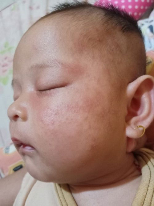 Bayi alergi dari asi
