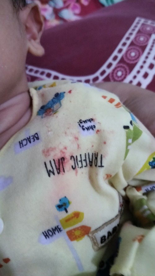 Gumoh ada bercak darah