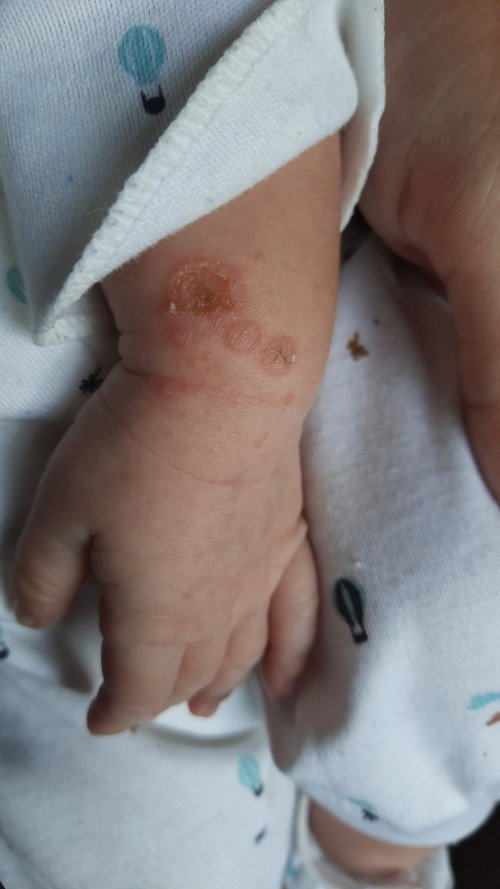 Luka di tangan bayi