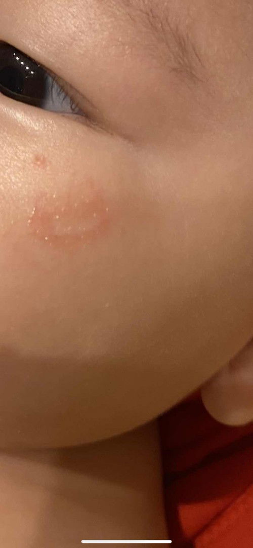 What rash is this?