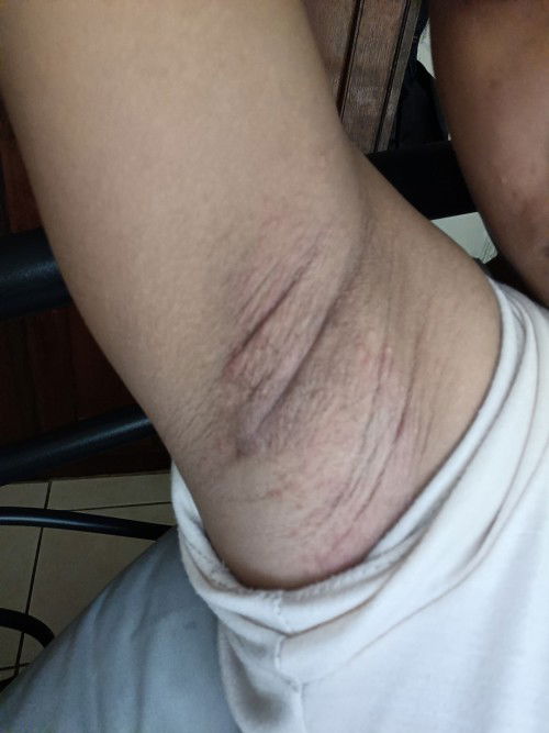 pag susugat ng kilikili