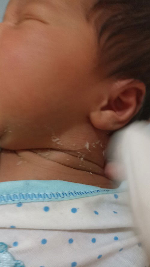 New born kulitnya kelupas