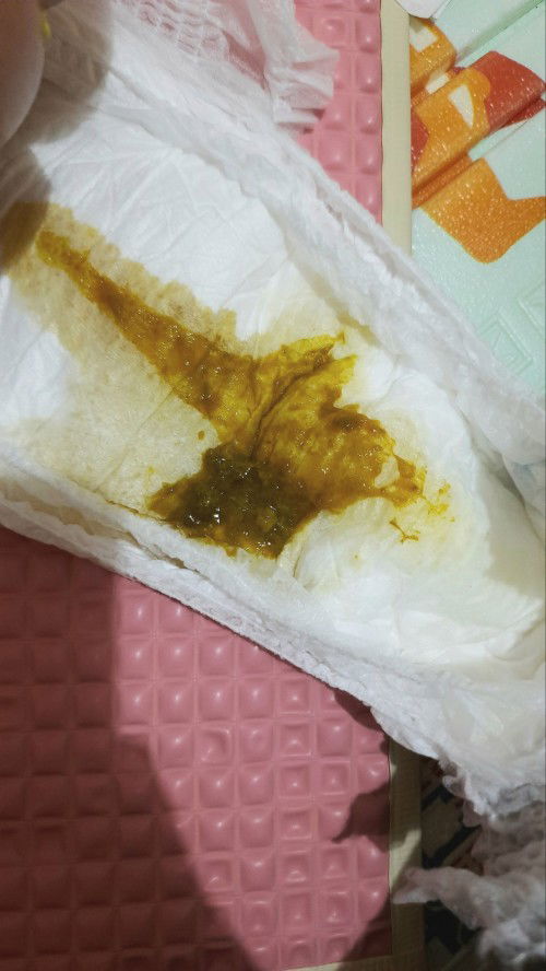 Anak 4 bulan demam, bapil