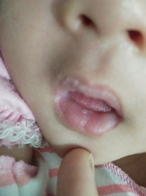 Bintik putih pada bibir bayi 6 minggu
