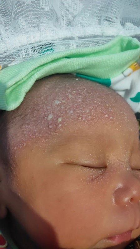 Bintik putih berair newborn