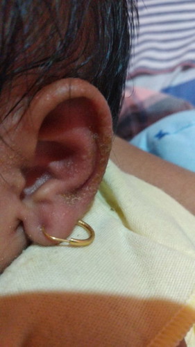 Daun telinga baby berkerak, merah,dan bau