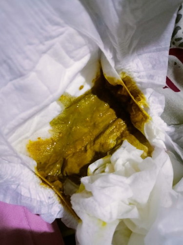 Green watery poop every other day nag ppoop formula fed