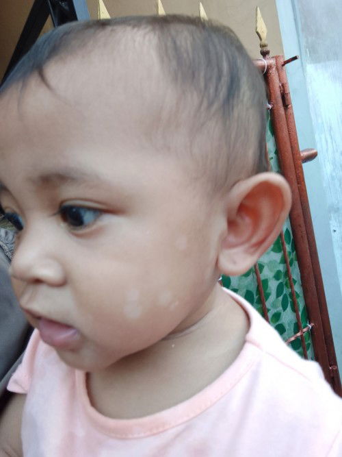 Putih putih d wajah bayi
