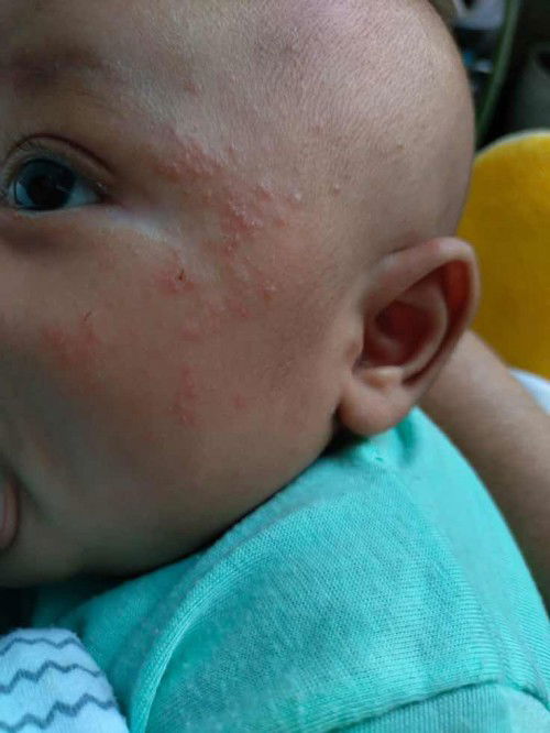 Bintik2 merah di pipi