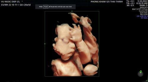 1 chiếc Em bé 26w